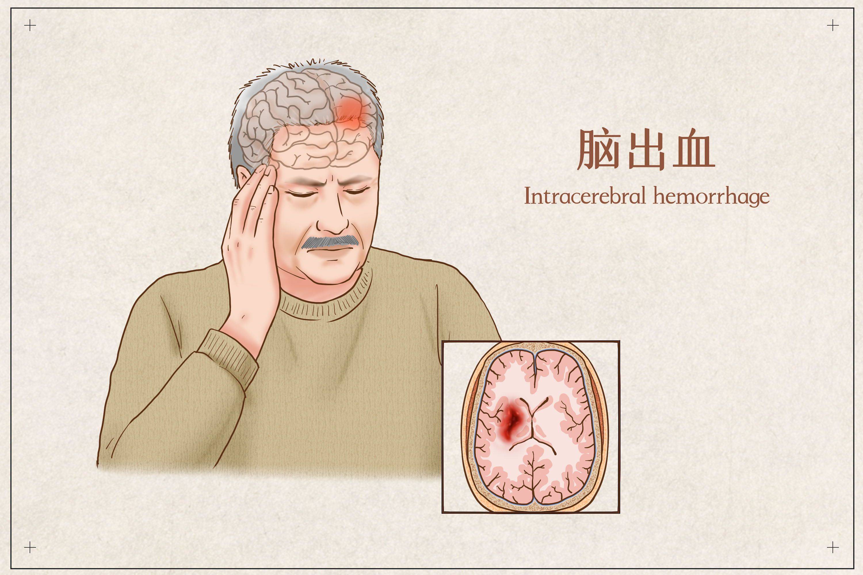 吃一次或等于5斤猪油?26岁女子脑溢血离世,医生:4种早餐需少吃