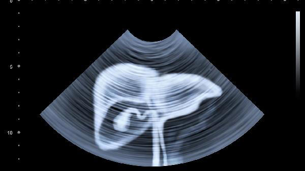 肝病开始恶化，身上或有这几个异常，若是发现了一个，尽早去医院