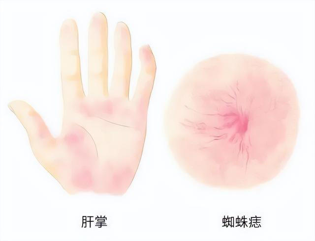 肝不好的人留意 “一黄二红三黑”，这些可能是肝脏发出的警报！