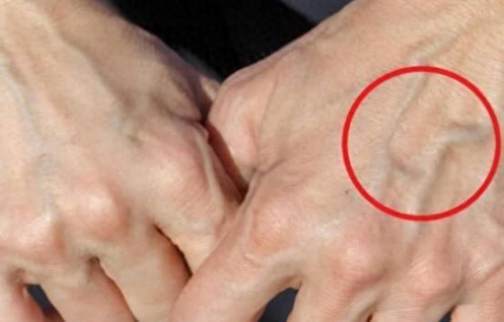 手背血管能看出寿命长短？医生：血管若有这些特征，恭喜你很健康