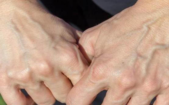 手背血管能看出寿命长短？医生：血管若有这些特征，恭喜你很健康