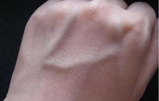 手背血管能看出寿命长短？医生：血管若有这些特征，恭喜你很健康