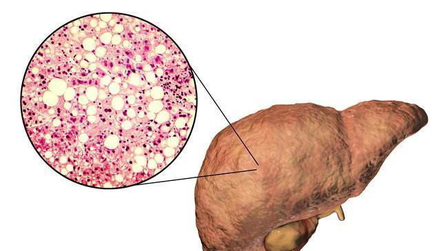 脂肪肝患者治疗时要避免四种错误行为，否则可能适得其反！