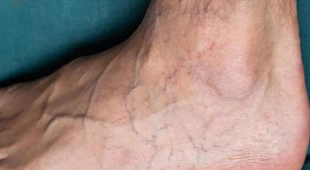 为什么有人手臂青筋凸起，有的人几乎看不到青筋，这是怎一回事？