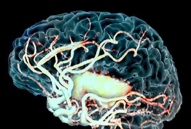 脑供血不足的人，起床时常有4种表现，若你没有，说明大脑很健康