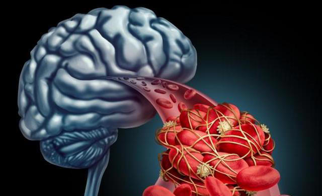 脑供血不足的人，起床时常有4种表现，若你没有，说明大脑很健康