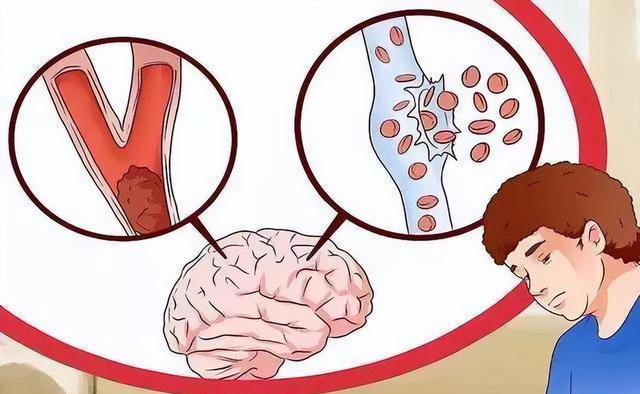 脑供血不足的人，起床时常有4种表现，若你没有，说明大脑很健康