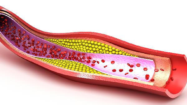 预防心脑血管疾病吃什么好？医生：除了饮食，遵循这6点很重要
