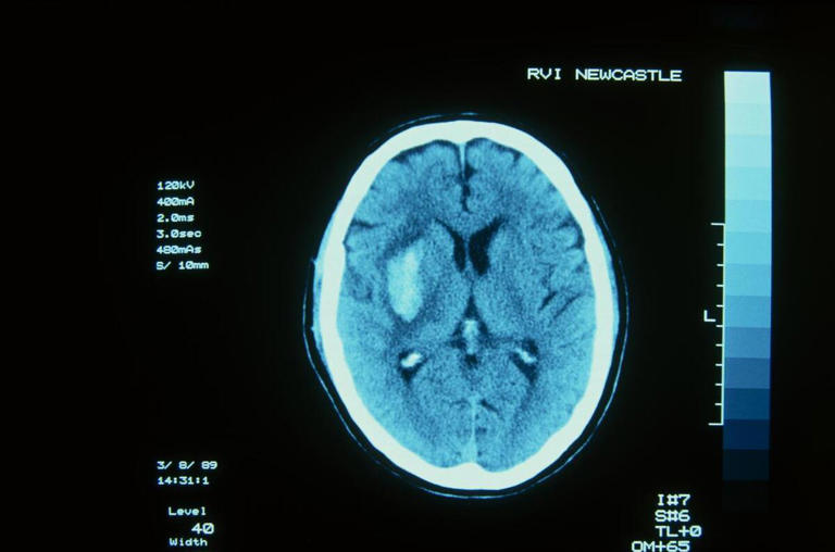 高血压会出现5个严重并发症，注意预警信号，做好3点预防