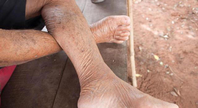 警告：肾病发出的第一个信号，通常在脚上，很多人都没放心上