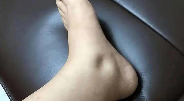 警告：肾病发出的第一个信号，通常在脚上，很多人都没放心上