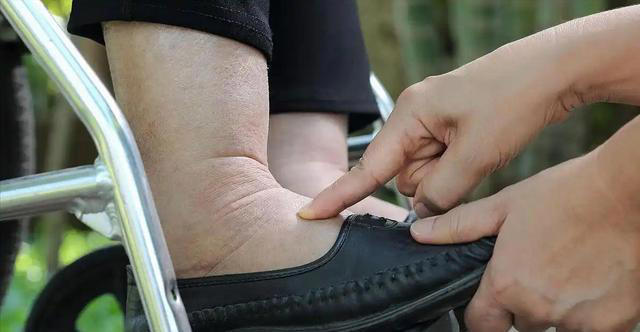 警告：肾病发出的第一个信号，通常在脚上，很多人都没放心上