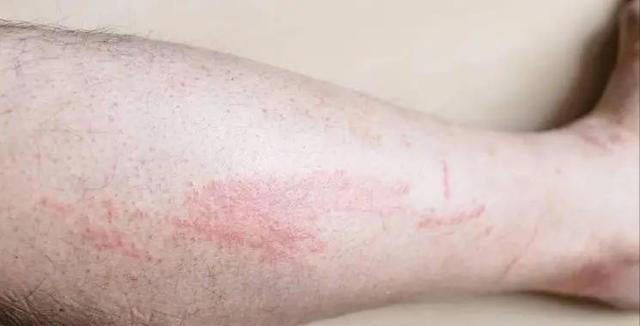 警告：肾病发出的第一个信号，通常在脚上，很多人都没放心上