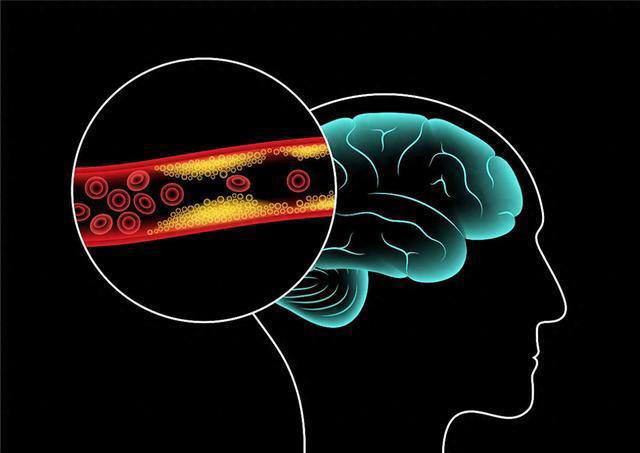 医生建议：为了远离脑梗和脑出血，50岁以上的人养成5个好习惯