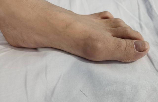 痛风不能吃海鲜？提醒：真正不能吃的食物，已列成清单，建议收藏