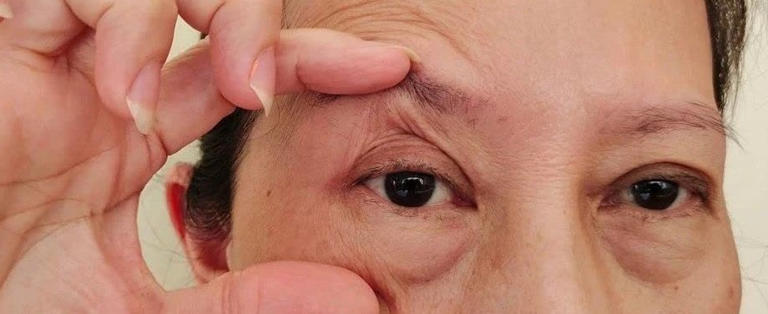 眼白有个小黑点，正常吗？有这些特点要当心