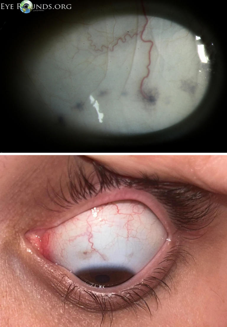 眼白有个小黑点，正常吗？有这些特点要当心