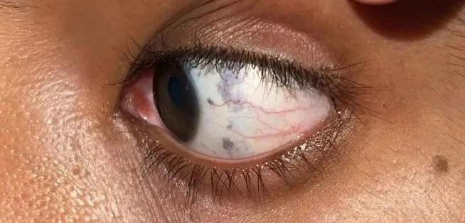 眼白有个小黑点，正常吗？有这些特点要当心