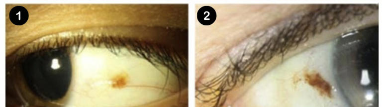 眼白有个小黑点，正常吗？有这些特点要当心