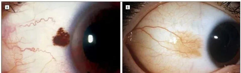眼白有个小黑点，正常吗？有这些特点要当心