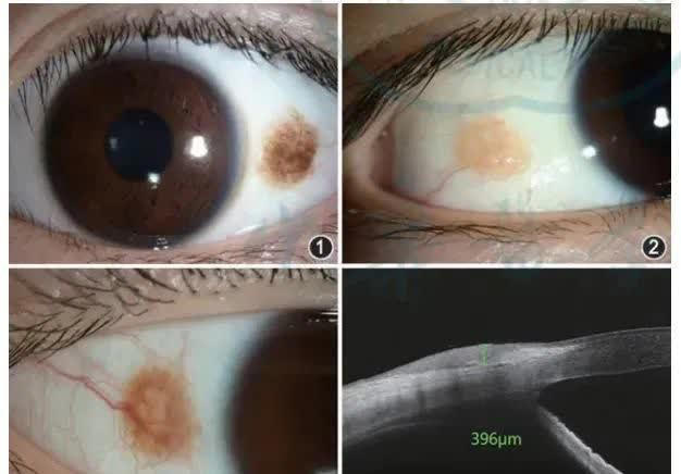 眼白有个小黑点，正常吗？有这些特点要当心