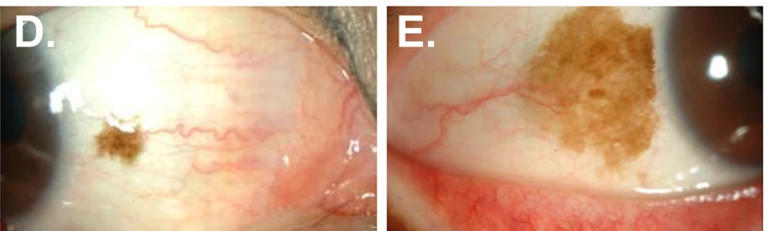 眼白有个小黑点，正常吗？有这些特点要当心