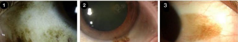 眼白有个小黑点，正常吗？有这些特点要当心