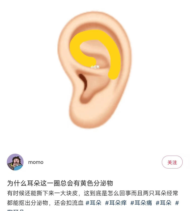 真的想问：耳朵周围黄黄的分泌物，到底是什么？