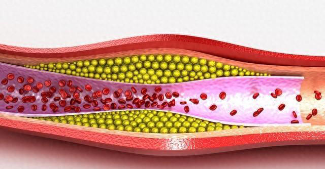 血脂太高怎么办？记住“三吃三不吃”