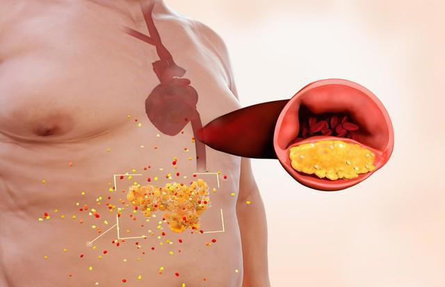 血脂太高怎么办？记住“三吃三不吃”