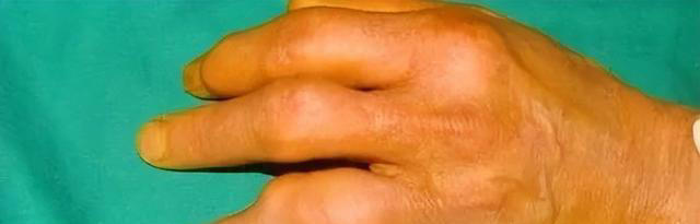 “嘌呤王”发现了，是猪肉的42倍，专家提醒：想远离痛风，早戒