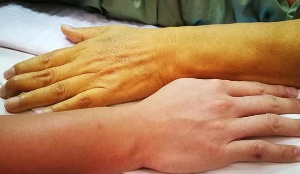 为何肝癌发现即晚期？建议：若有“2软2痛1肿”，早检查为妙