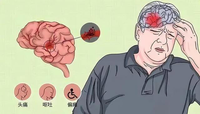 大脑开始萎缩，一般出现4个反应，多吃5种健脑食物，辅助降低风险