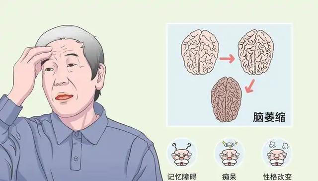 大脑开始萎缩，一般出现4个反应，多吃5种健脑食物，辅助降低风险