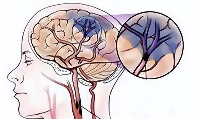 大脑开始萎缩，一般出现4个反应，多吃5种健脑食物，辅助降低风险