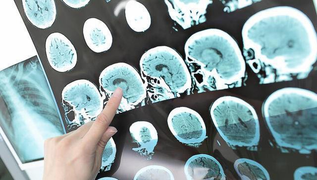 大脑开始萎缩，一般出现4个反应，多吃5种健脑食物，辅助降低风险