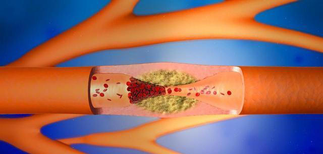 “脑出血”和“脑梗塞”，哪一个恢复起来更麻烦？很多人不知道