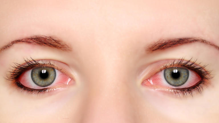  眼睛是高血压的“显示器”？医生：眼睛若有这3个异常，尽快就医 