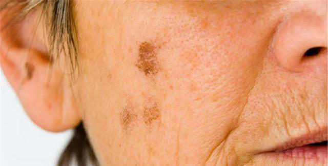 能不能长寿，皮肤有暗示？老年人斑点越少，或活得越久？医生咋说