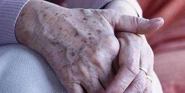 能不能长寿，皮肤有暗示？老年人斑点越少，或活得越久？医生咋说