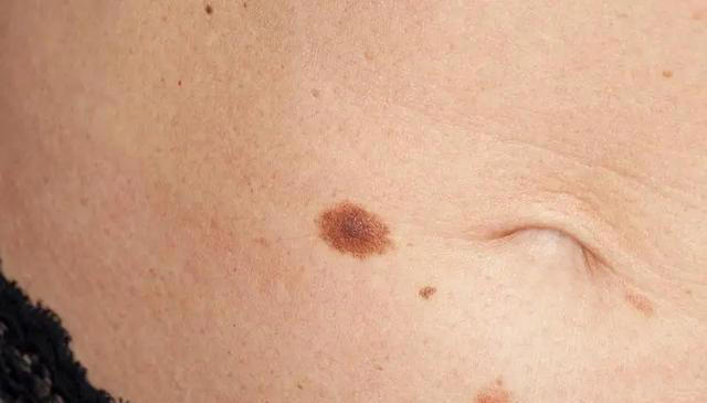 能不能长寿，皮肤有暗示？老年人斑点越少，或活得越久？医生咋说