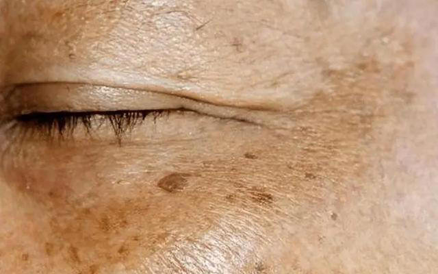 能不能长寿，皮肤有暗示？老年人斑点越少，或活得越久？医生咋说