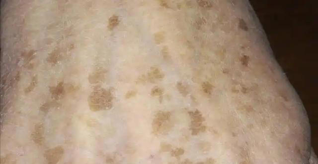 能不能长寿，皮肤有暗示？老年人斑点越少，或活得越久？医生咋说