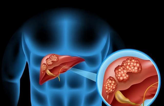 脂肪肝离世者增多！医生反复提醒：少喝粥，多吃这4种护肝佳品