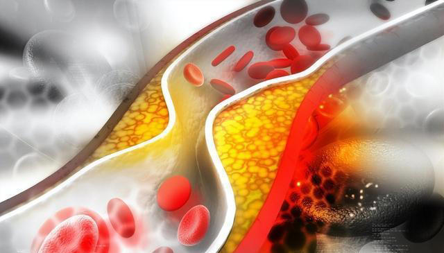 医生警示：中国脑梗发病率世界第一！4物是祸根，早戒早安