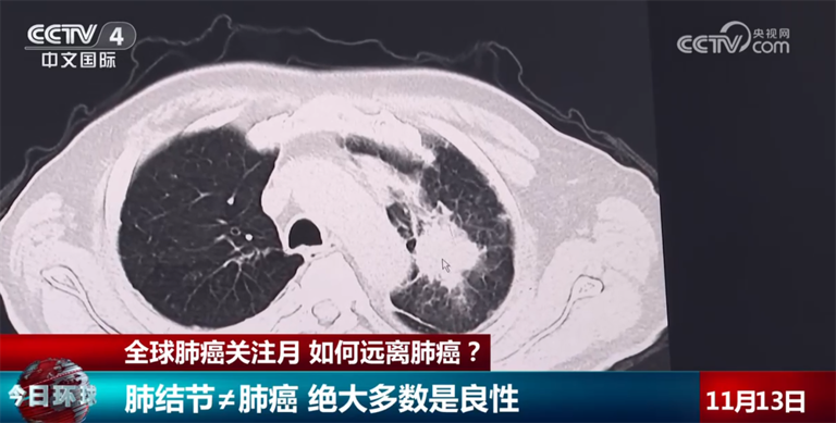 肺结节是否需要立刻手术？如何远离肺癌？这篇关于健康的提示请收藏↓