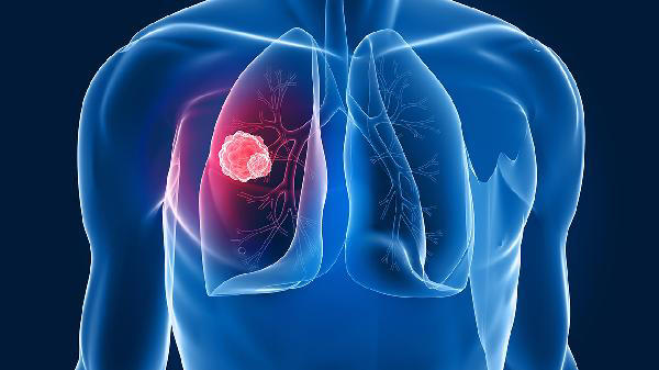 头部若出现3种异常，可能是肺癌的信号，是时候做一下检查了