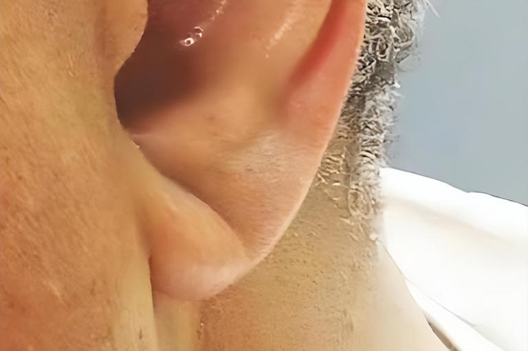 耳朵是心梗的预警器？医生：耳朵出现这4个症状，抓紧去医院