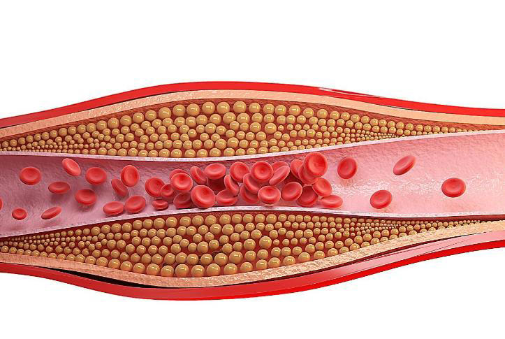 张大叔今年54岁。最近两个月，他总感觉自己的右耳朵莫名地发麻，偶尔还冒出些“皱纹”，连老婆都打趣是不是最近操心得太多导致“未老先衰”。最让他在意的是，有一次照镜子时，发现自己耳垂处突然多出一条斜向的折痕。 邻居建议他去医院看看，不以为然的张