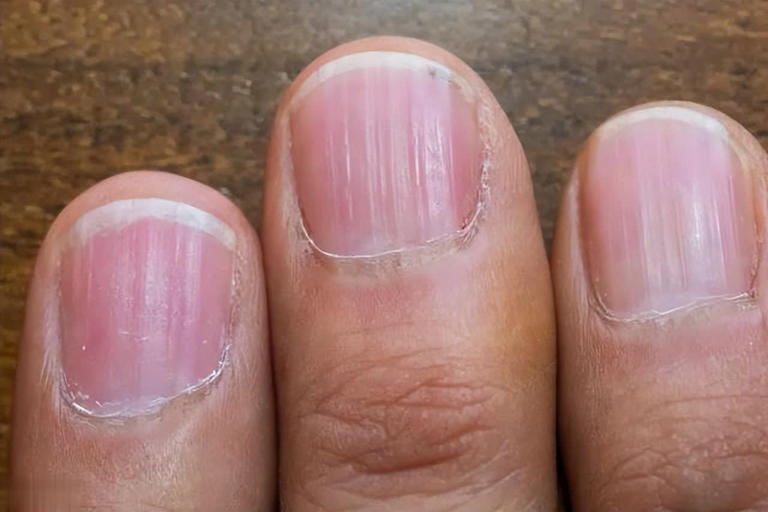 提醒：肾衰竭早期不是腰疼，而是身上4大异常要注意